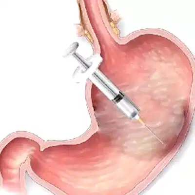 MİDE BOTOKSU